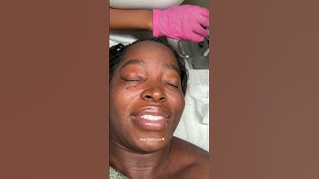 BURNING MY MOLES OFF 😱I got more DPN Moles AFTER PREGNANCY & THEY GOTTA GO🔥 #shorts #shortvideo