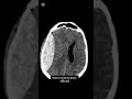 epidural hematoma |everything you need to know|@ambitiousdoc-l8q