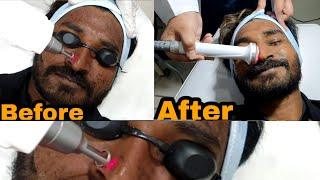 Phoolllu LASER Skin Toning And Peeling || Glowing Skin || Bodevolution Lahore