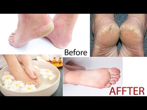 How to Transform Your Feet in 2 Weeks: Home Remedies Tips You Need to Know!