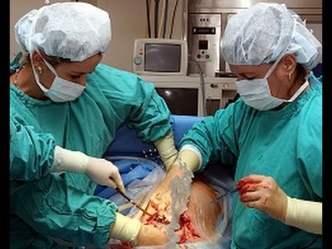 Cesarean Delivery