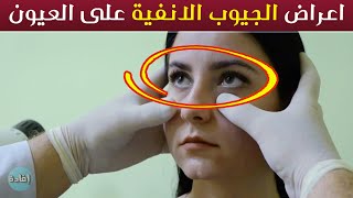 اعراض الجيوب الانفية على العيون