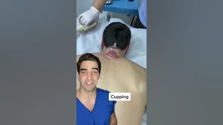 Cupping, does it work?