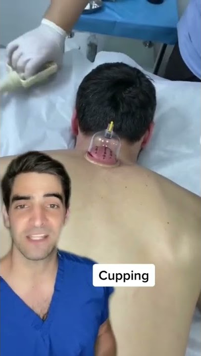 Cupping, does it work?