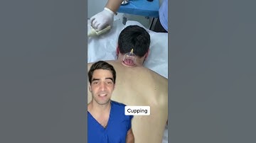 Thumbnail of Cupping, does it work?