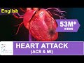 HEART ATTACK (ACS & MI)