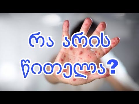 რა არის წითელა?|Health|Measles|Disease|GKF|Kartuli|Vaccine