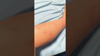 I have 36 bug bites. I just took a shower so so you won’t see that much.