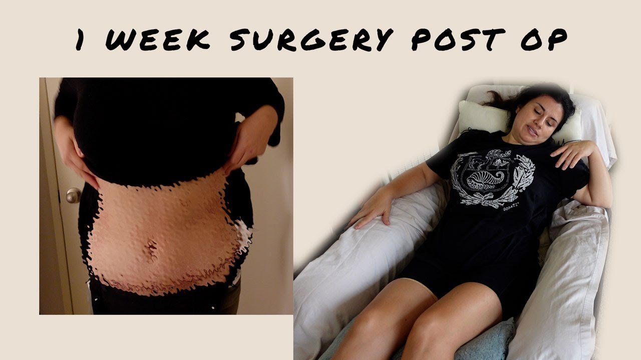 tummy tuck journey blog