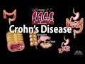 Crohn's Disease: Pathophysiology, Symptoms, Risk factors, Diagnosis and Treatments, Animation.