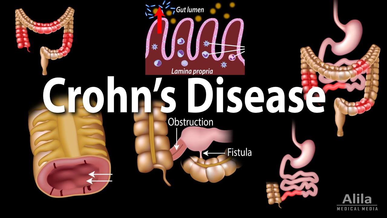 Crohn's Disease: Pathophysiology, Symptoms, Risk factors