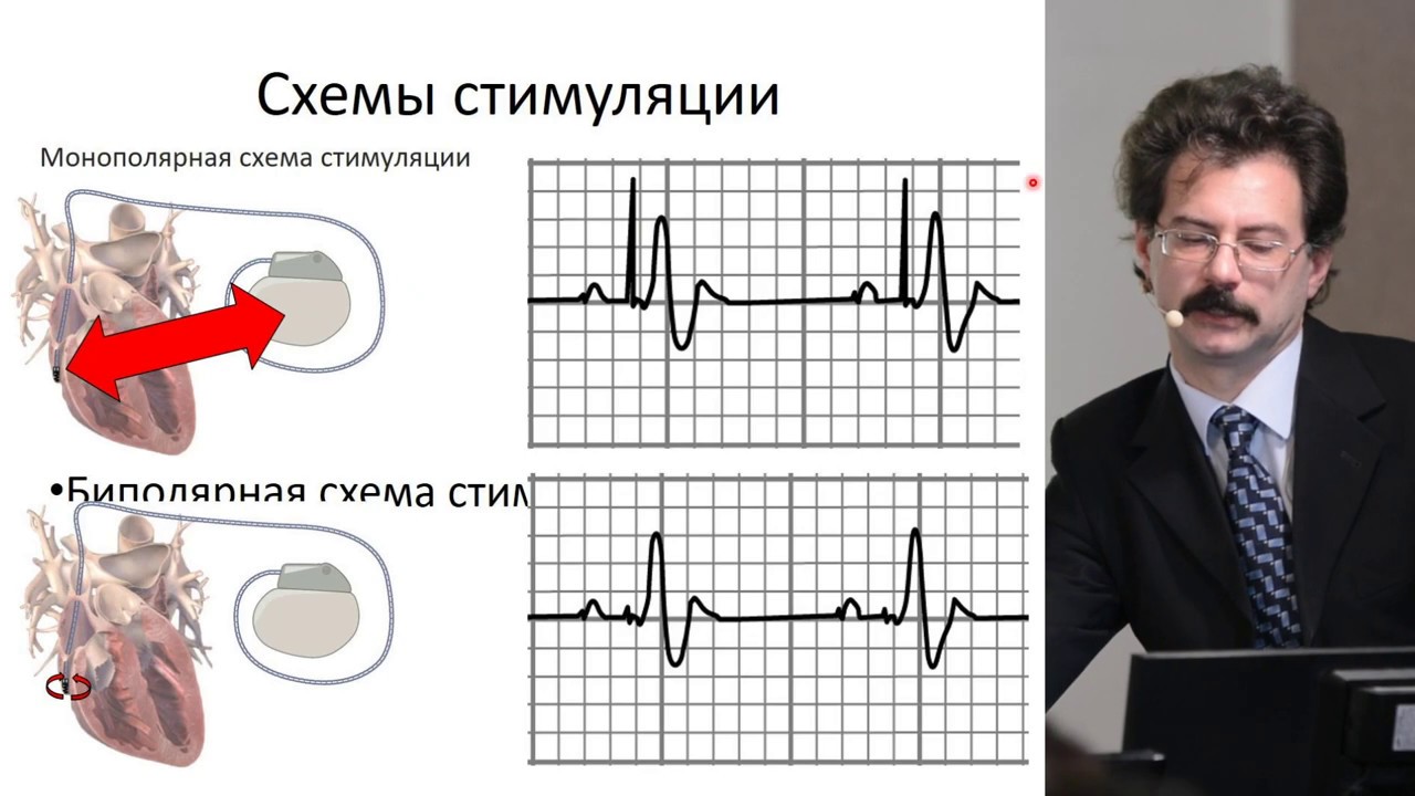 Часть 1. "Холтеровское мониторирование пациентов со стимулятором" - YouTube