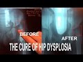 Dysplasia is curable by effect on DNA
