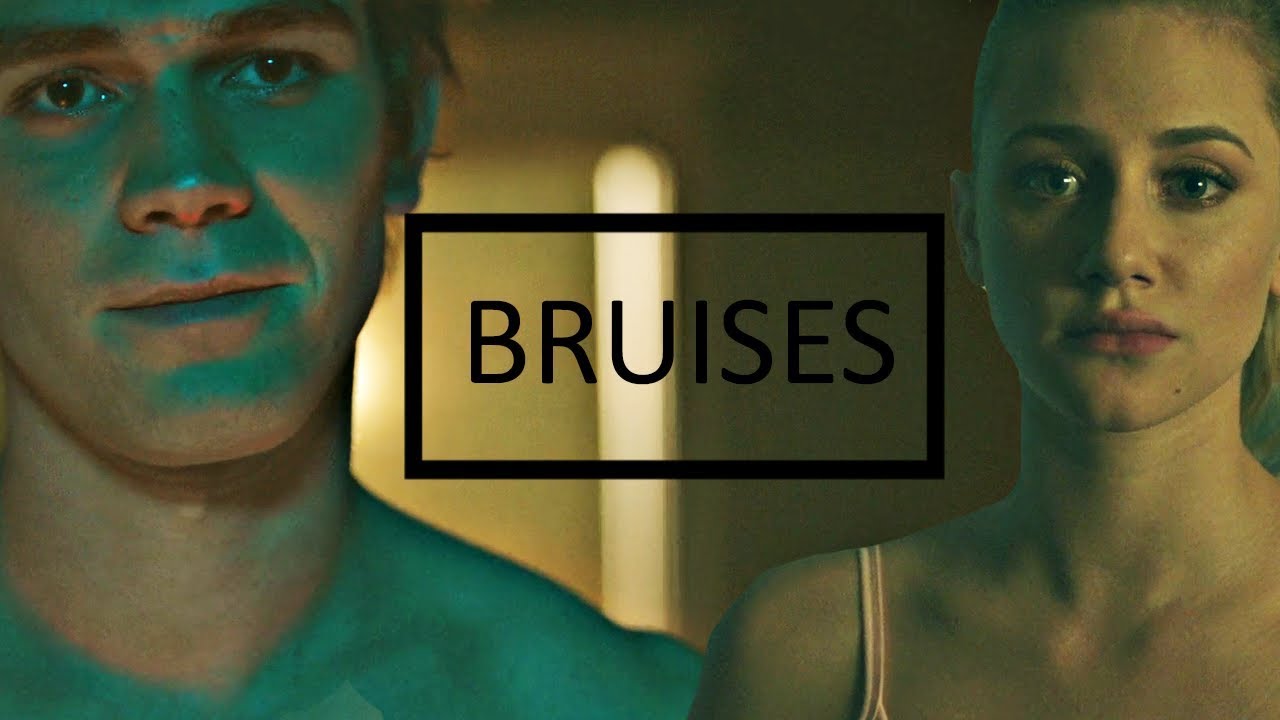 Betty & Archie | Bruises