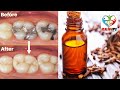 एक बार में दांत का कीड़ा और दर्द बाहर निकालने का बेहतरीन उपाय - How To Get Rid Of Tooth Cavity