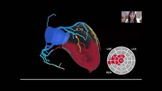 Coronary bypass surgery guided by computed tomography in a low risk population