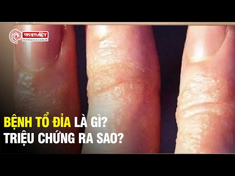 Tổ Đỉa Ở Trẻ Em - Tổ đỉa là căn bệnh như thế nào và triệu chứng của nó ra sao? - Cẩm Nang Sống Khỏe - Tuoitreviet TV