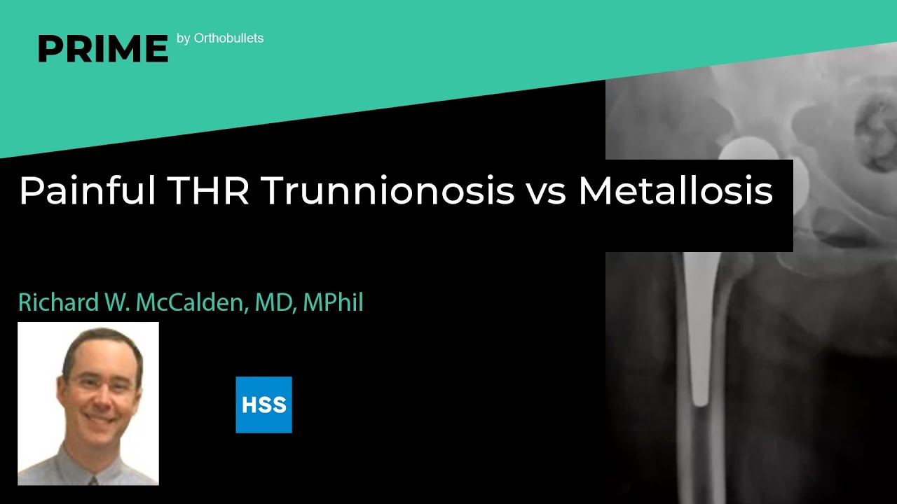 Painful THR Trunnionosis vs Metallosis Richard W. McCalden, MD, MPhil