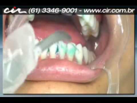 Profilaxia - Limpeza dental