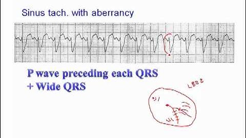 ECG: Sinus Rhythm with Aberrancy