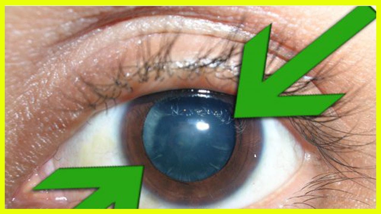 ¿A qué se debe la visión borrosa y cómo tratarla? YouTube ¿A qué se debe la visión borrosa y cómo tratarla? YouTube