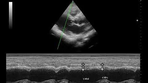 CASE 390 ECHO LEFT BUNDLE BRANCH BLOCK LBBB