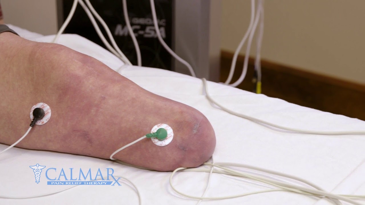 Scrambler Therapy for Phantom Limb Pain with CRPS YouTube