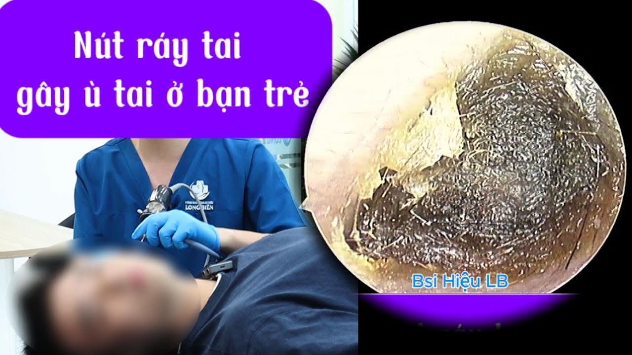 Lấy nút ráy tai – Giải thoát cảm giác ù tai cho bạn trẻ! 耳かき - ASMR耳掃除 ...