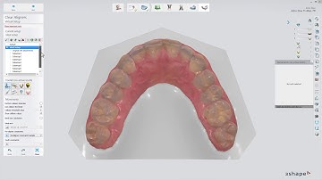 3Shape Clear Aligner Studio - Per-aligner Movement Constraints PL