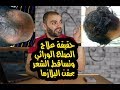 علاج الصلع الوراثي بالبلازما