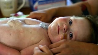 Baby Born With Heart Outside Her Chest