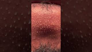 How to Remove oil in your Chin to prevent blackheads and pimples. Gently How to Remove oil in your Chin to prevent blackheads and pimples. Gently