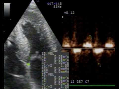 Cardiac Amyloidosis echo case by dr Chatziathanasiou-diagnosis, ECG, echo and treatment