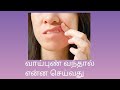 What to do if mouth ulcers occur in tamil