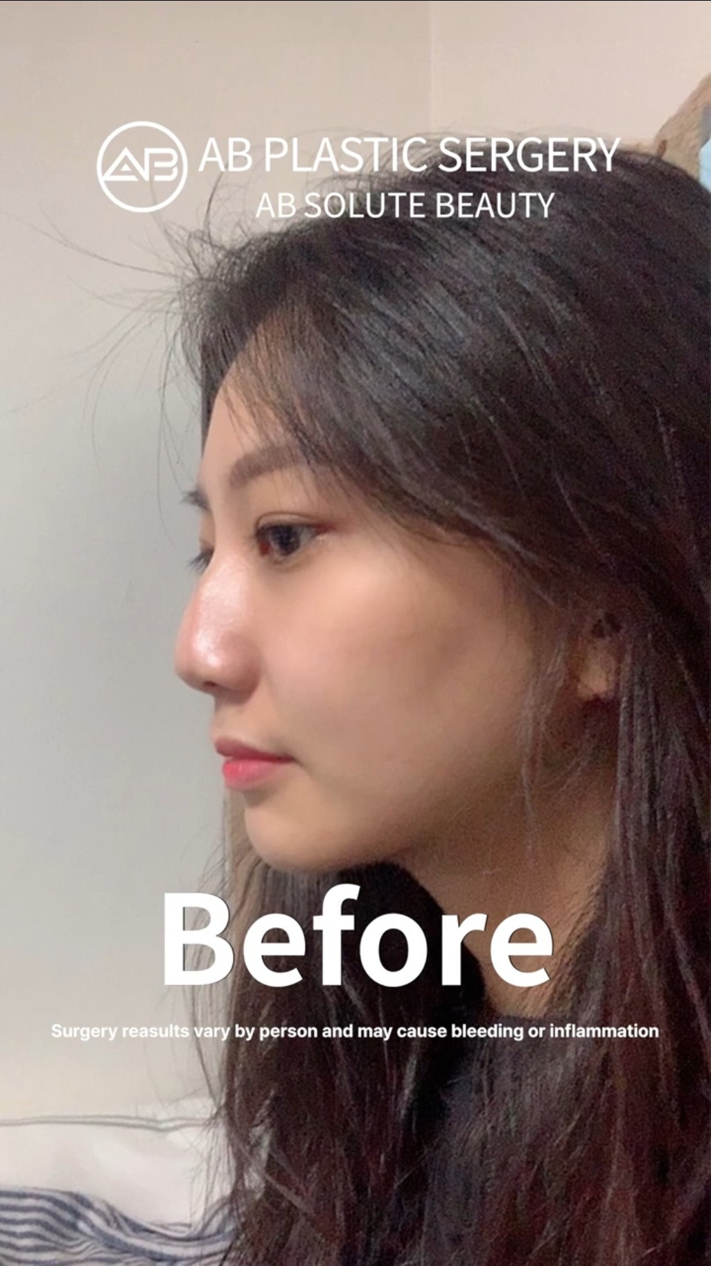 Stunning Nose Job Transformation Watch Her Glow Up #shorts