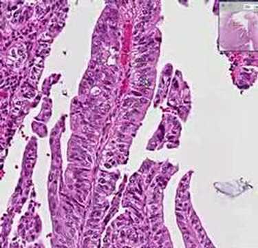 Histopathology Extrahepatic bile ducts, common bile duct--Ad - YouTube