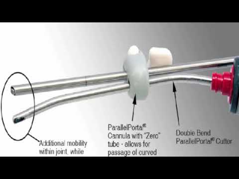 Single Portal Knee Arthroscopy: 2015 Technique Update