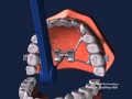 Advanced Orthodontics - Expanders