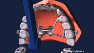 Advanced Orthodontics - Expanders