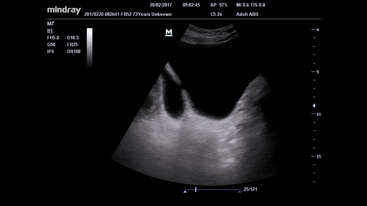 Ultrasound bladder diverticulum - YouTube