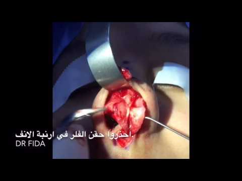 أضرار حقن مقدمة أرنبة الأنف بالفلر دكتور عبدالكريم فدا