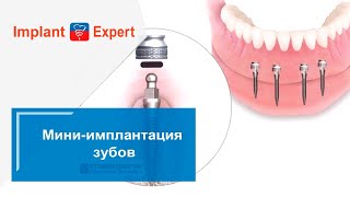 Мини-имплантация зубов