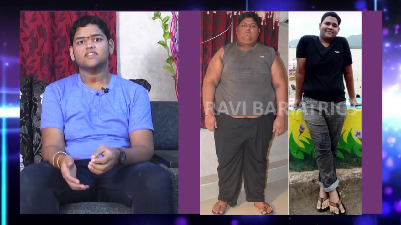 best bariatric surgery results by Dr Ravikanth kongara Hyderabad
