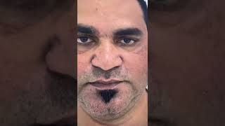 Male Nose job in India