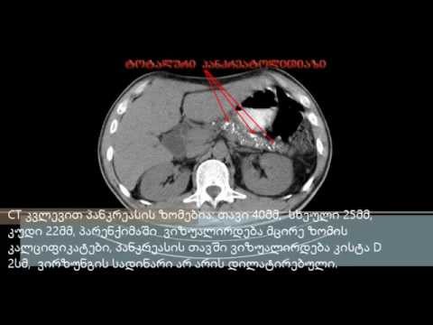 Бернский вариант операции бегера, вирзунгэктомия. ბეგერის ოპერაციის ბერნის ვარიანტი, ვირზუნგექტომია.