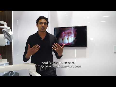 How to treat gum pigmentation and what causes it? - Periodontist answers