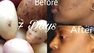 Removing Dark Spots in 7 Days 100% Natural | Acne Scars | Shellyposh Lifestyle.