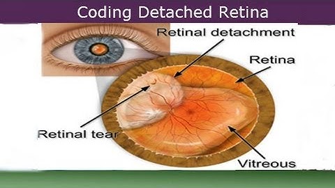 Medical Coding Detached Retina — Coding Diabetes Code 361.9 and 250.51