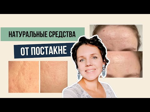 ПОСТАКНЕ - что это? Как избавиться от постакне | эффективные средства от рубцов