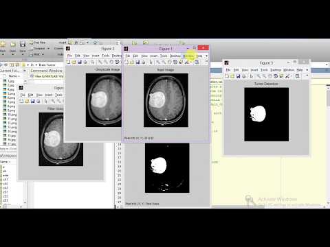 Brain Tumor Detection and Classification Using Matlab | Brain Tumor Prediction Analysis